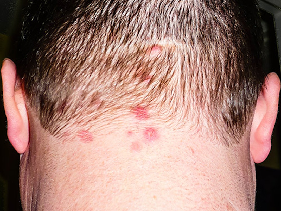 Dermatitis herpetiformis