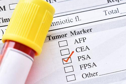 What you need to know about the PSA test